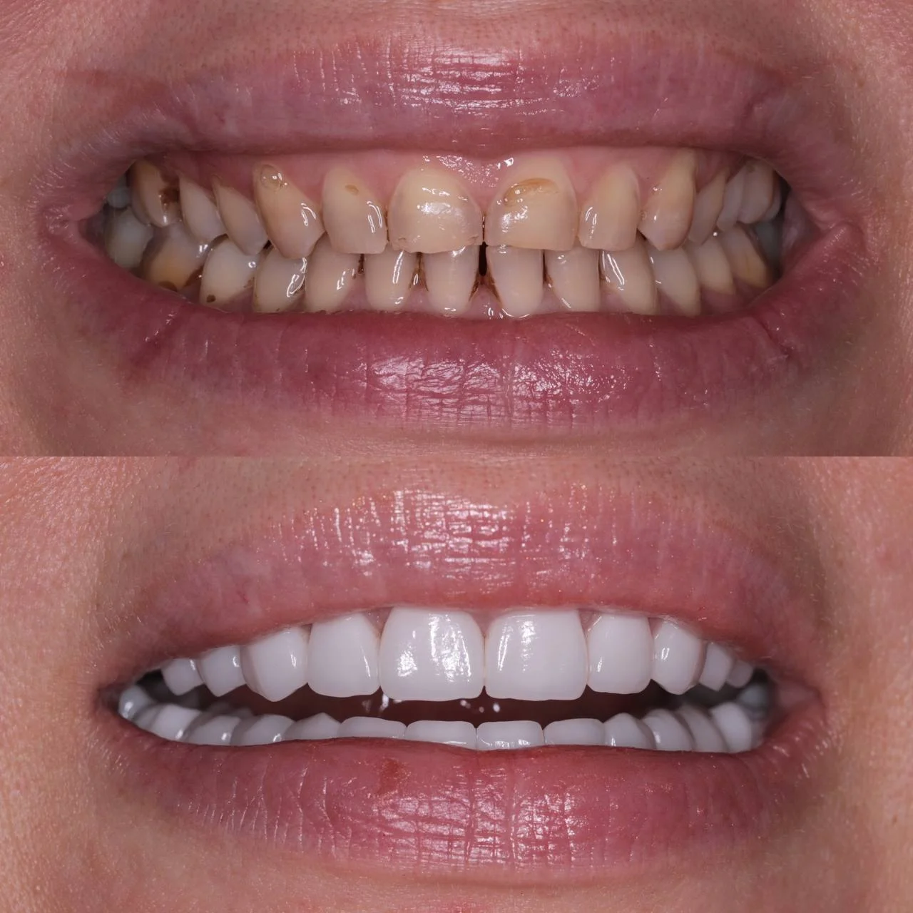 Голливудская улыбка — виниры до и после, клиника Pro.зубы Калининград