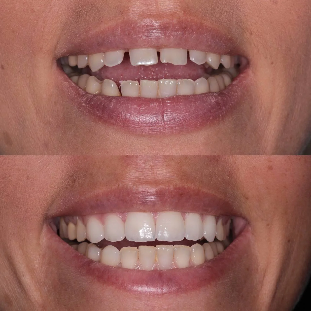 Виниры E.max — фото до и после установки, 6 виниров на верхнюю челюсть