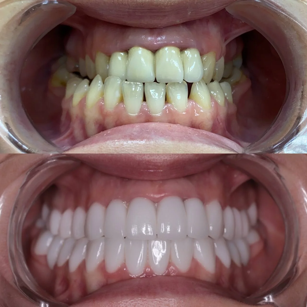 Циркониевые коронки — фото до и после протезирования жевательных зубов