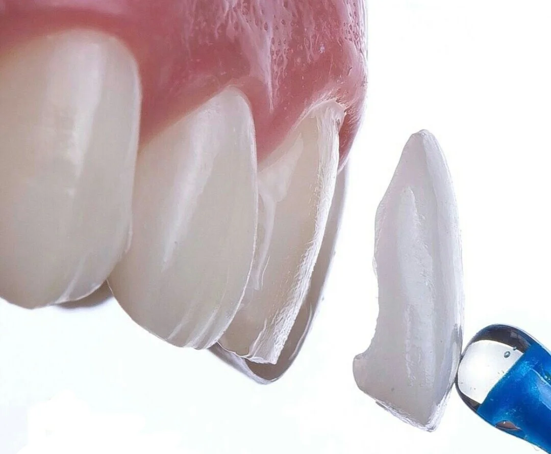 Виниры E.max в Калининграде — прессованная керамика на зубы